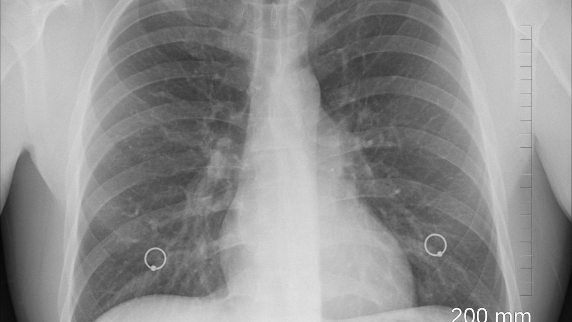 Tumore al polmone, causa Covid sono diminuiti i pazienti arruolati negli studi clinici
